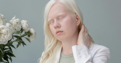 Casting homme et femme atteint d’albinisme entre 20 et 60 ans pour tournage film publicitaire