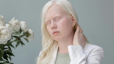 Casting homme et femme atteint d’albinisme entre 20 et 60 ans pour tournage film publicitaire