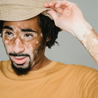 Casting homme avec vitiligo entre 25 et 35 ans pour publicité avec marque de prêt à porter