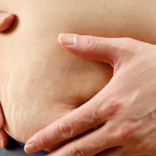 Casting femme avec cicatrice et vergetures sur le ventre pour tournage publicité