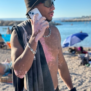 Vitiligo92